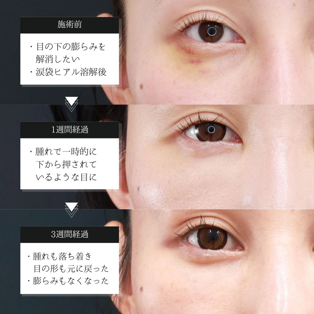下眼瞼脱脂術（目の下のたるみ取り・目の下の脂肪ふくらみ取り）/顔の脂肪注入(コンデンスリッチフェイス)の症例写真 施術前後 