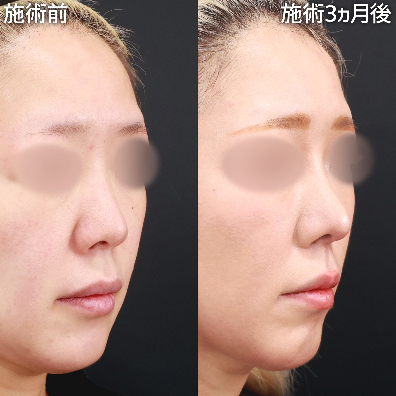 【鼻中隔延長】短いお鼻に長さを出し、自然な変化でアップデート！