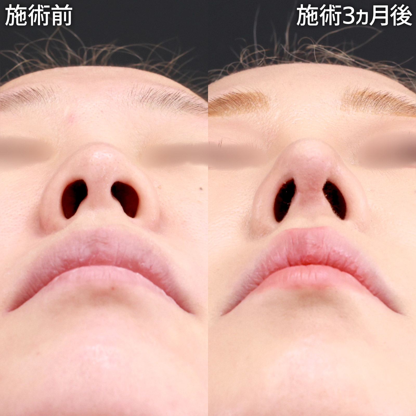 鼻中隔延長術/鼻先軟骨移植/鼻尖形成・鼻尖縮小の症例写真 施術前後