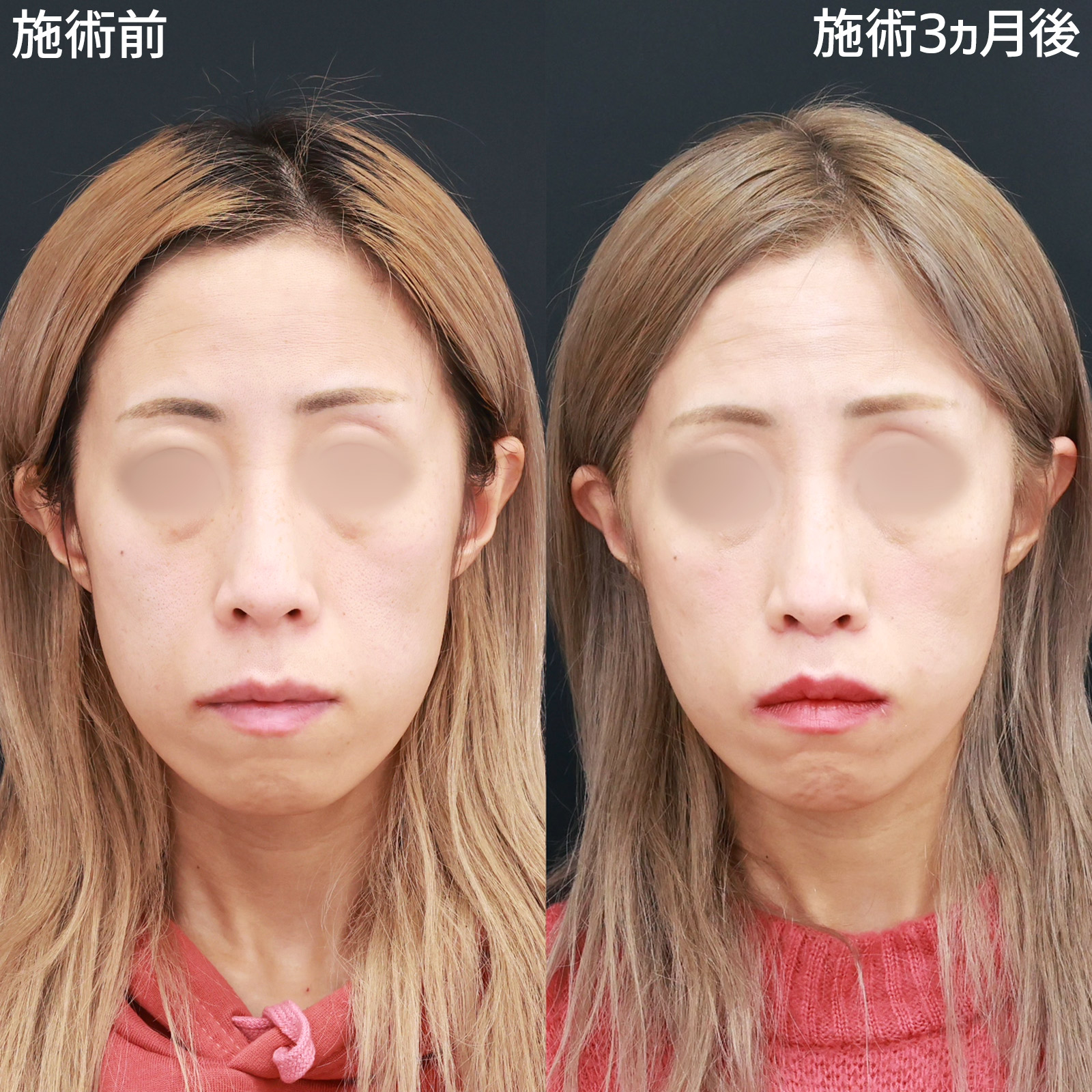 人中短縮術(リップリフト)・外側人中短縮術の症例写真 施術前後