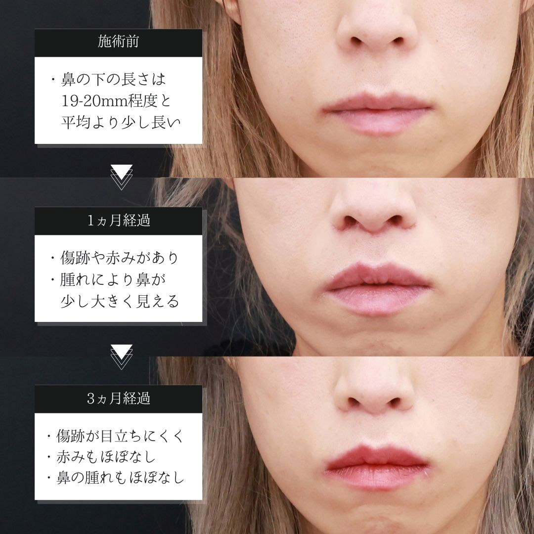 人中短縮術(リップリフト)・外側人中短縮術の症例写真 施術前後