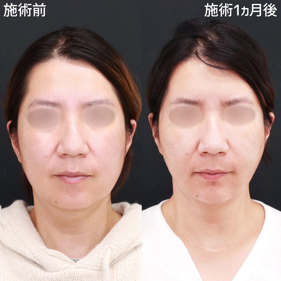 【パーフェクトフェイスライン】小顔複合施術でナチュラルな若返りを叶える