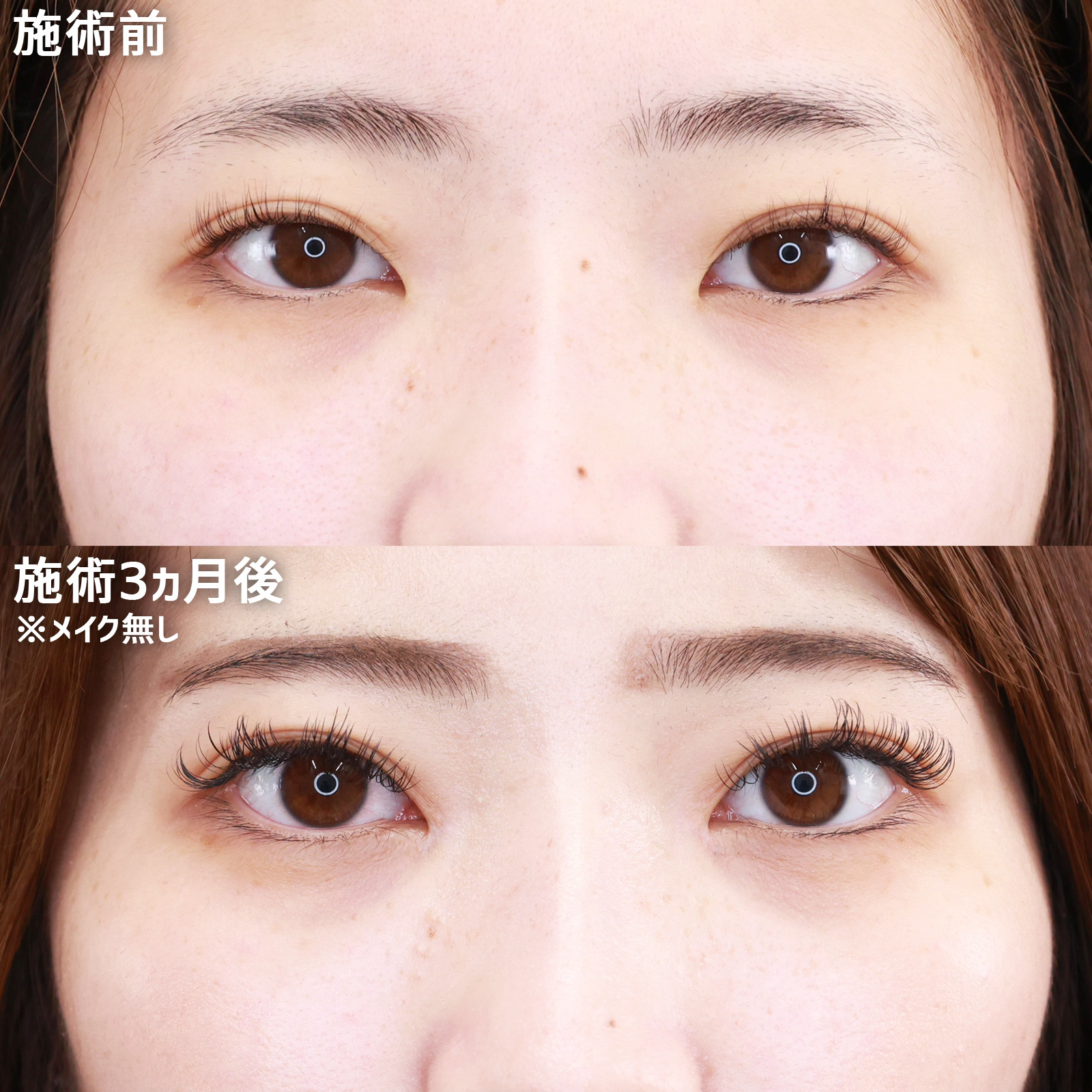 目頭切開術の症例写真 施術前後