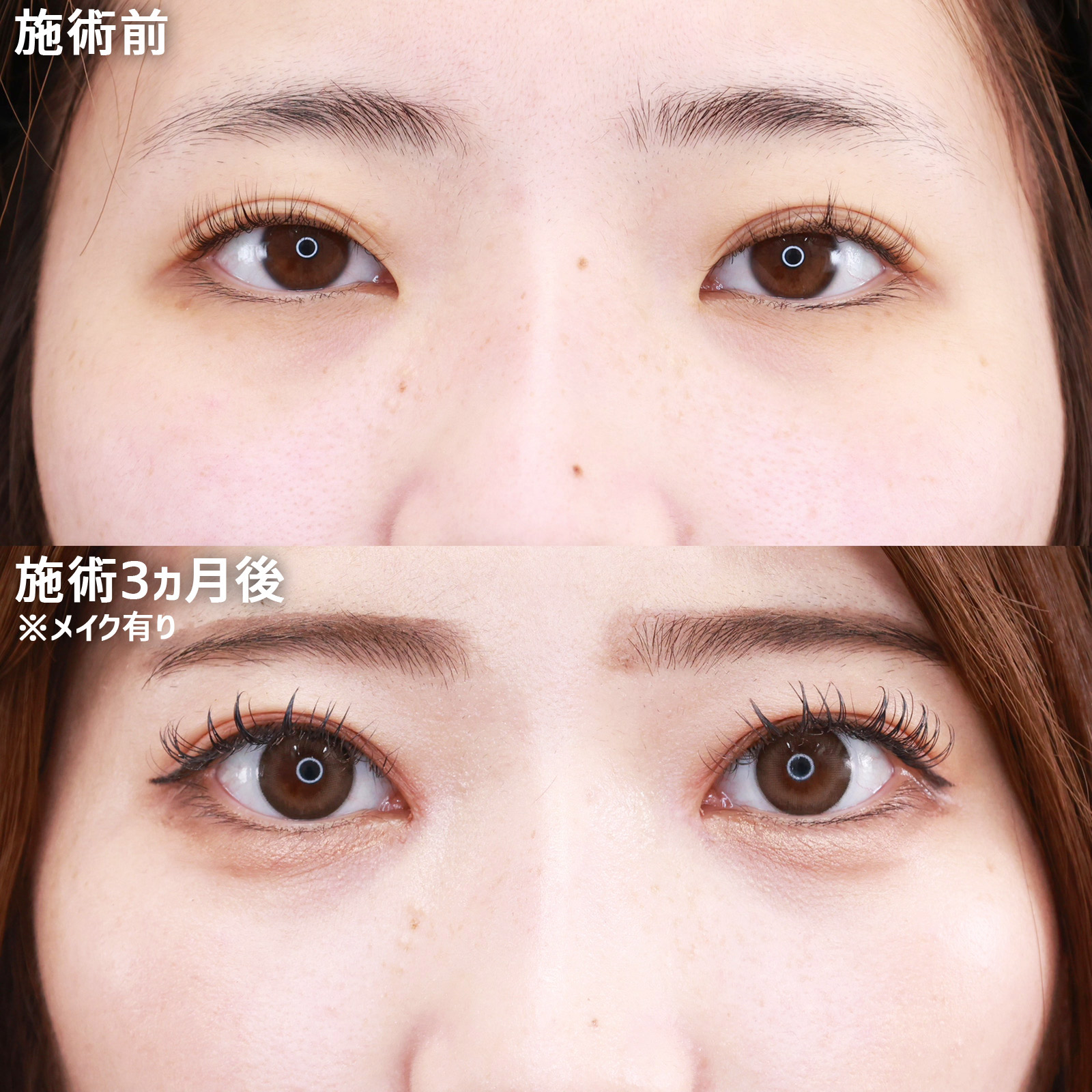 目頭切開術の症例写真 施術前後