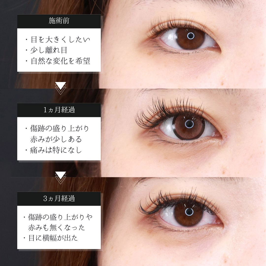 目頭切開術の症例写真 施術前後