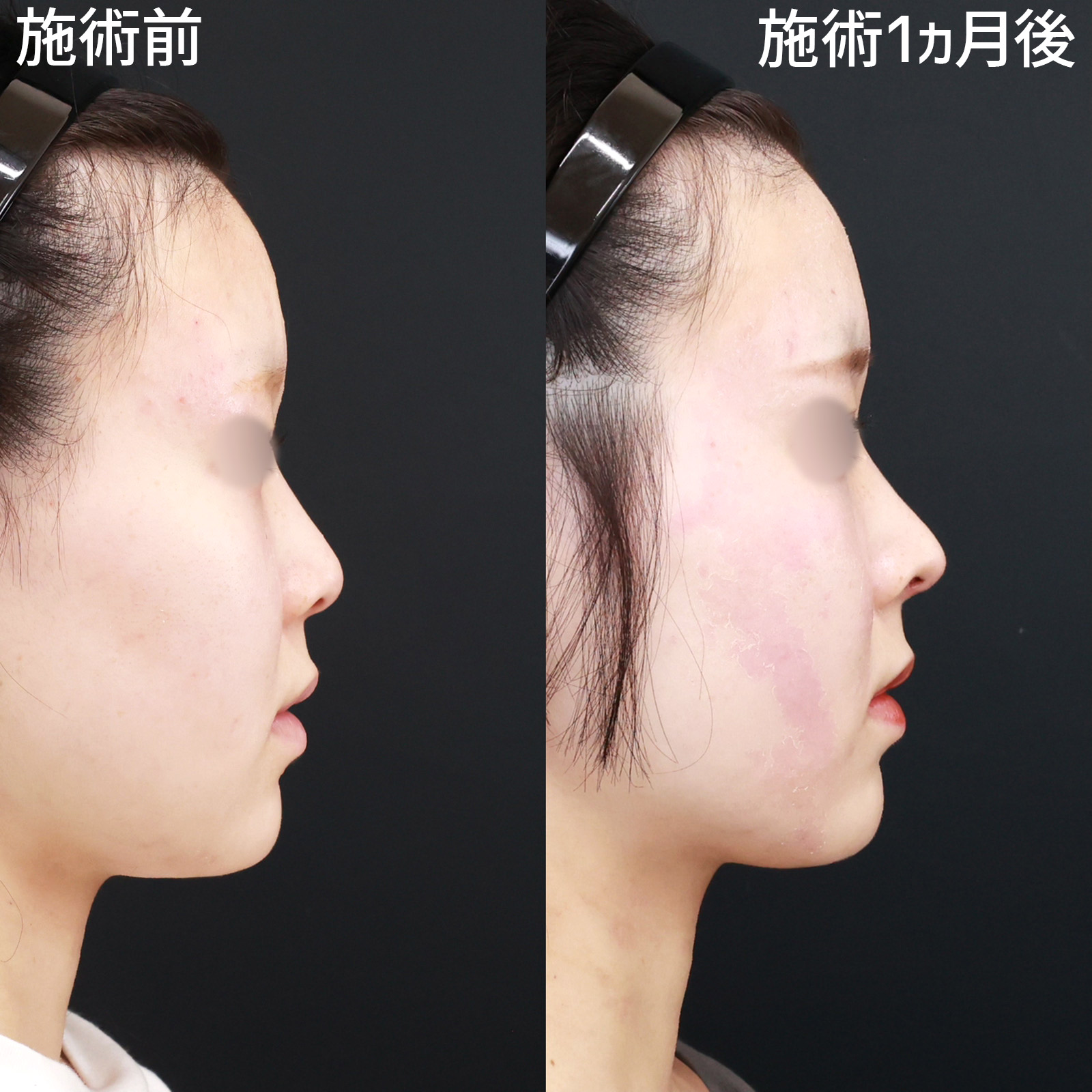 鼻先軟骨移植/鼻尖形成・鼻尖縮小の症例写真 施術前後