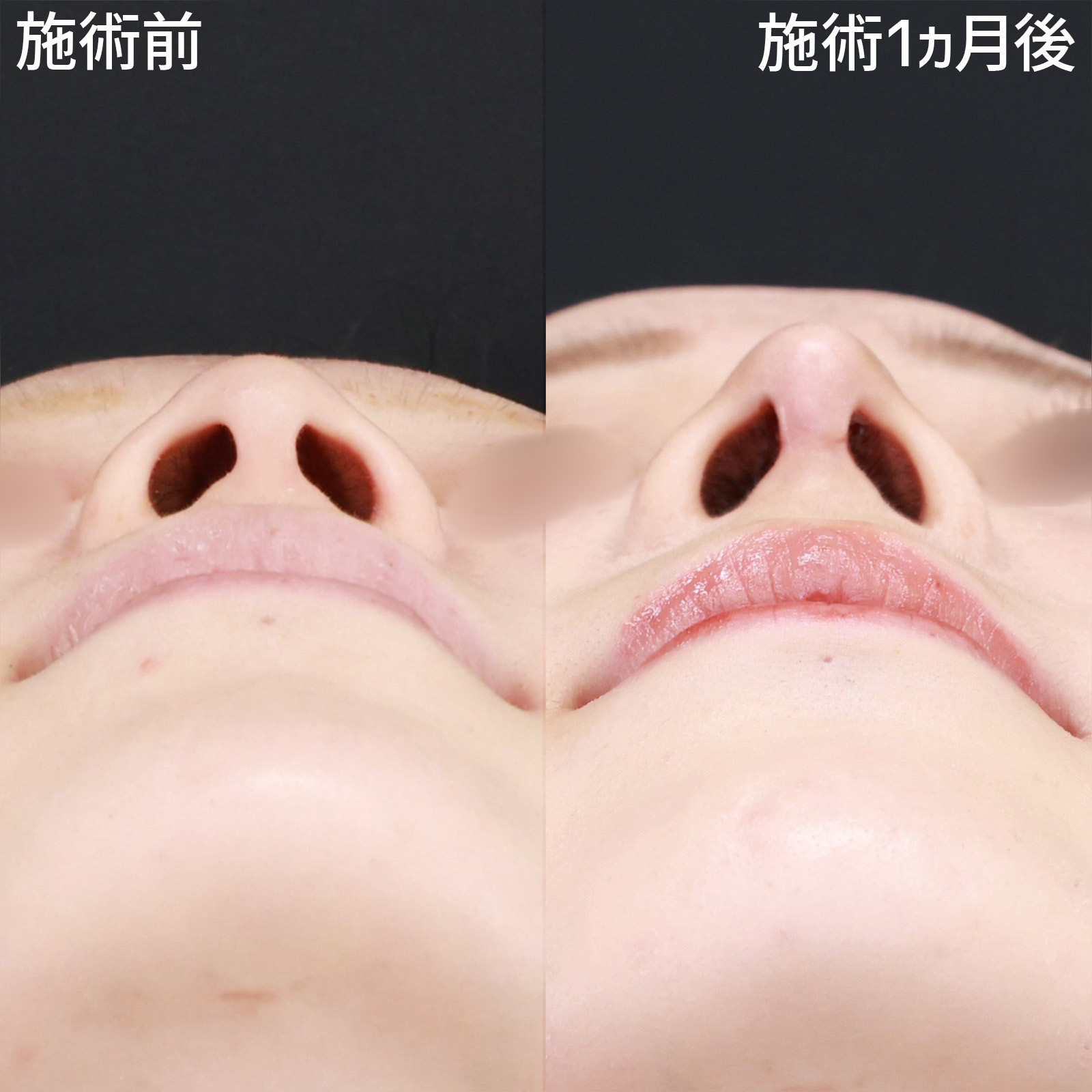 鼻先軟骨移植/鼻尖形成・鼻尖縮小の症例写真 施術前後