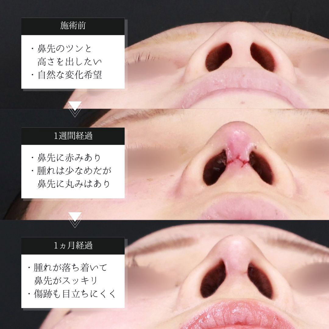 鼻先軟骨移植/鼻尖形成・鼻尖縮小の症例写真 施術前後