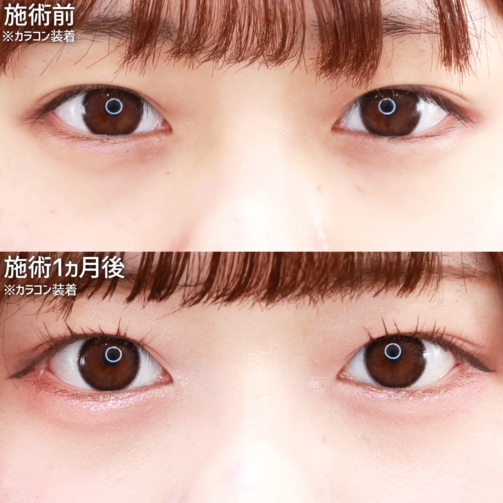 グラマラスライン（タレ目形成）/目尻切開術の症例写真 施術前後 