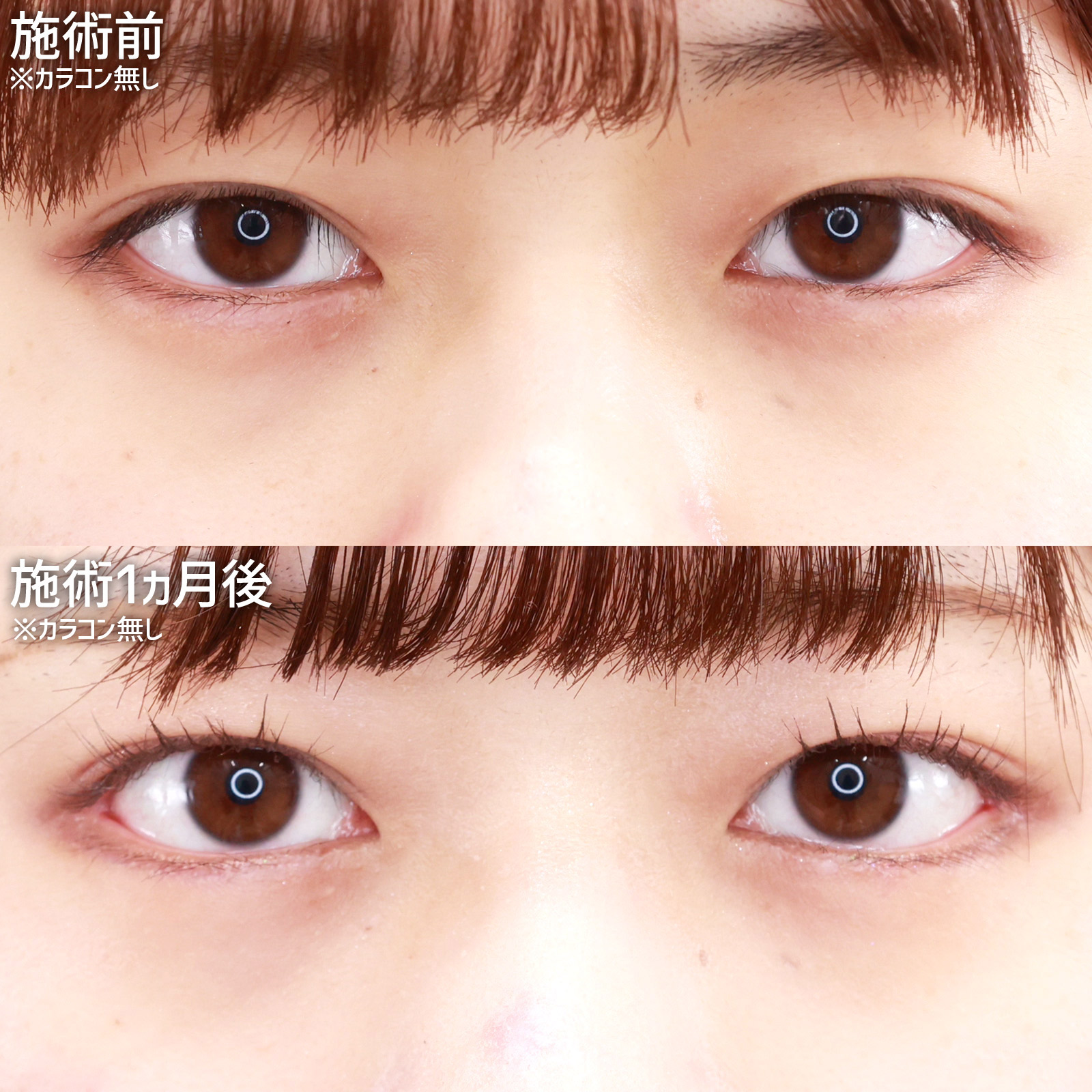 グラマラスライン（タレ目形成）/目尻切開術の症例写真 施術前後 