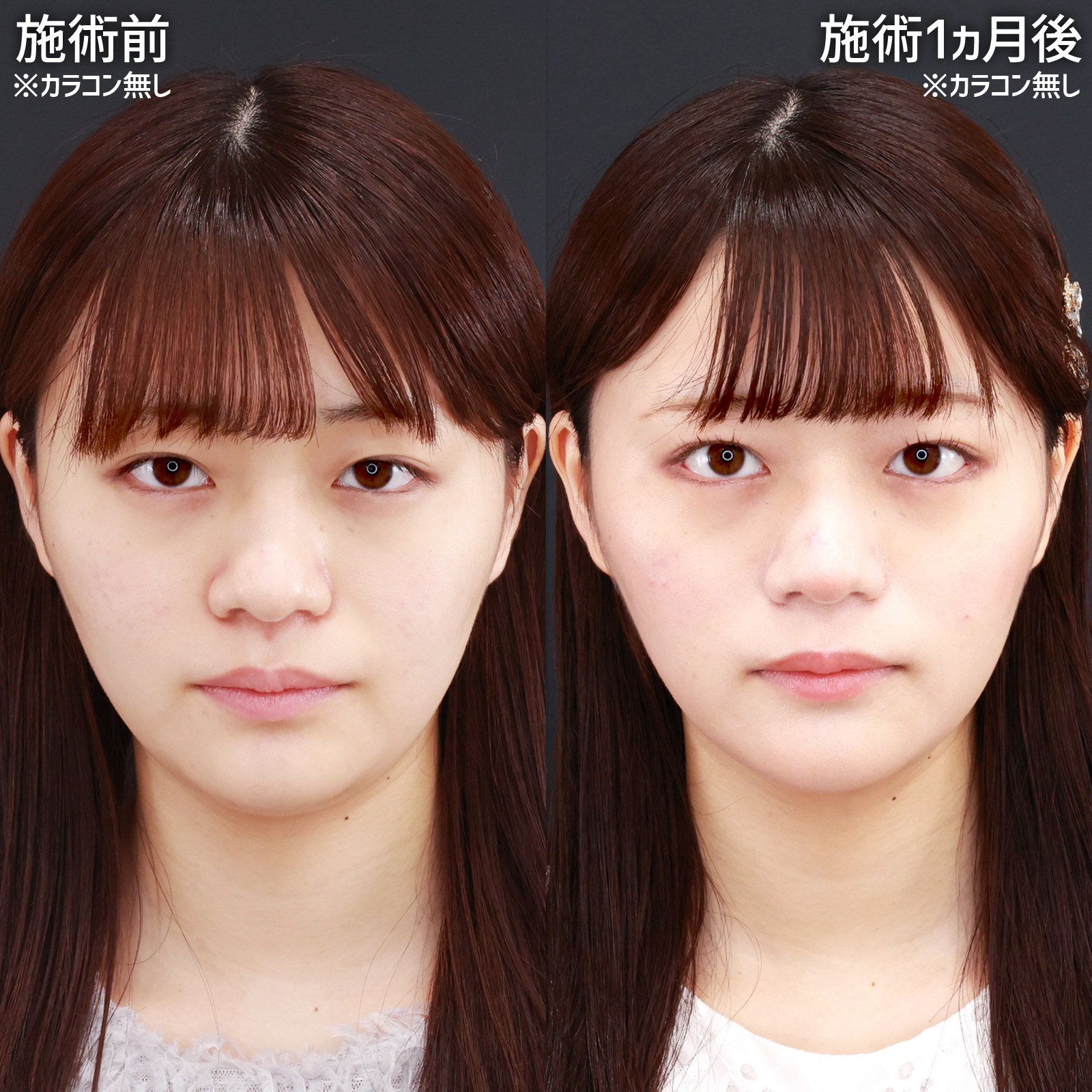 グラマラスライン（タレ目形成）/目尻切開術の症例写真 施術前後 