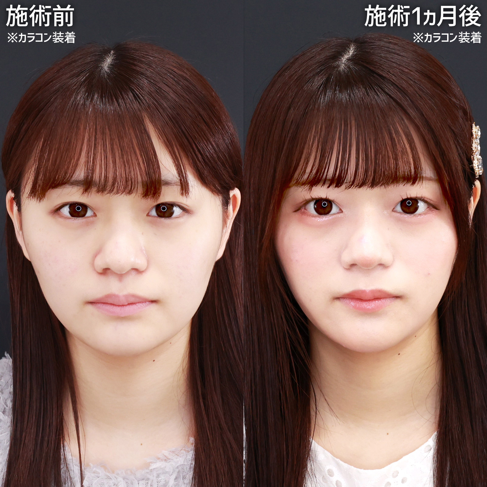 【たれ目形成】グラマラスラインと目尻切開で自然に目元を大きく！