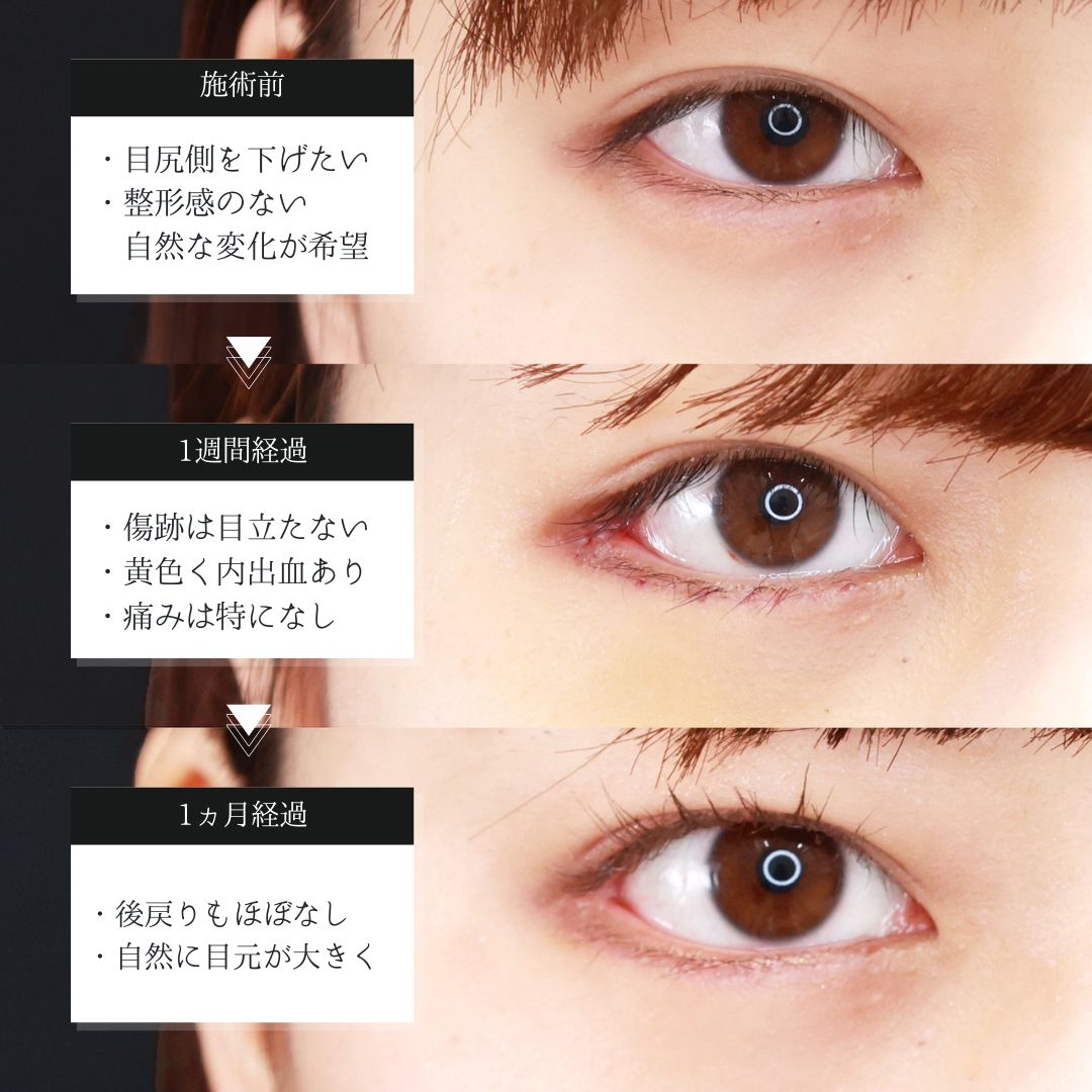 グラマラスライン（タレ目形成）/目尻切開術の症例写真 施術前後 