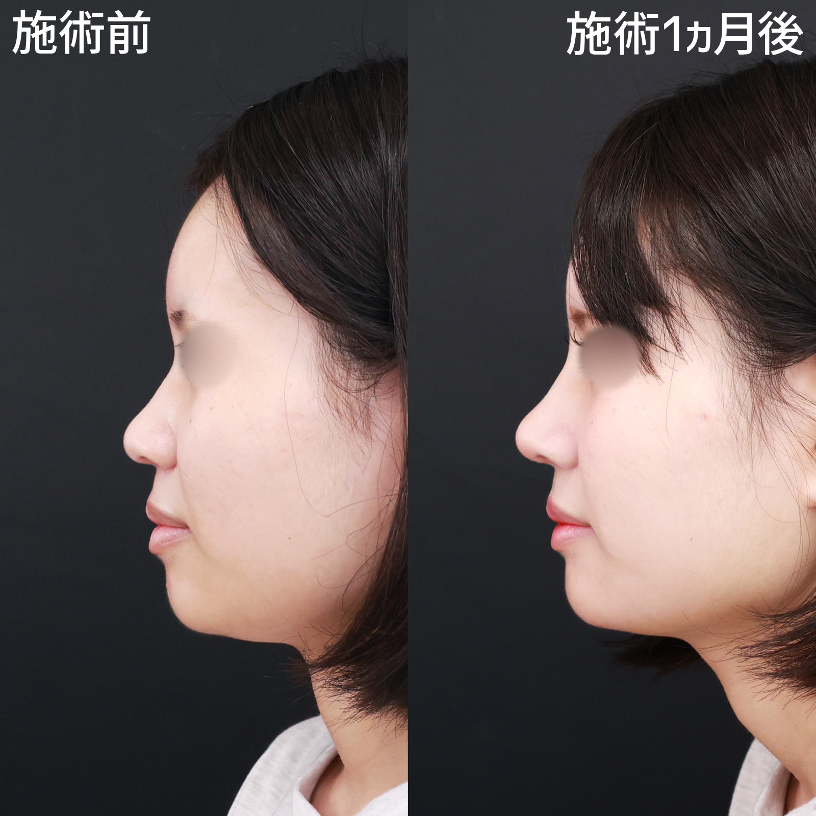 【鼻尖形成＆軟骨移植】コルメラストラット法も併用し、スッキリとした美しい鼻を形成