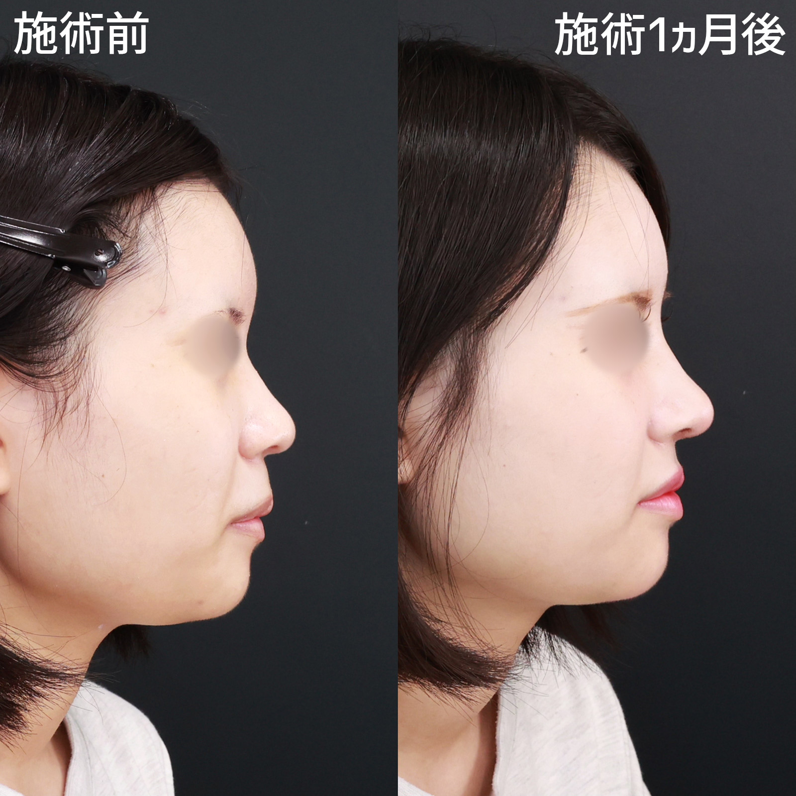 鼻尖形成・鼻尖縮小/鼻先軟骨移植/隆鼻術（プロテーゼ・自家組織）の症例写真 施術前後 