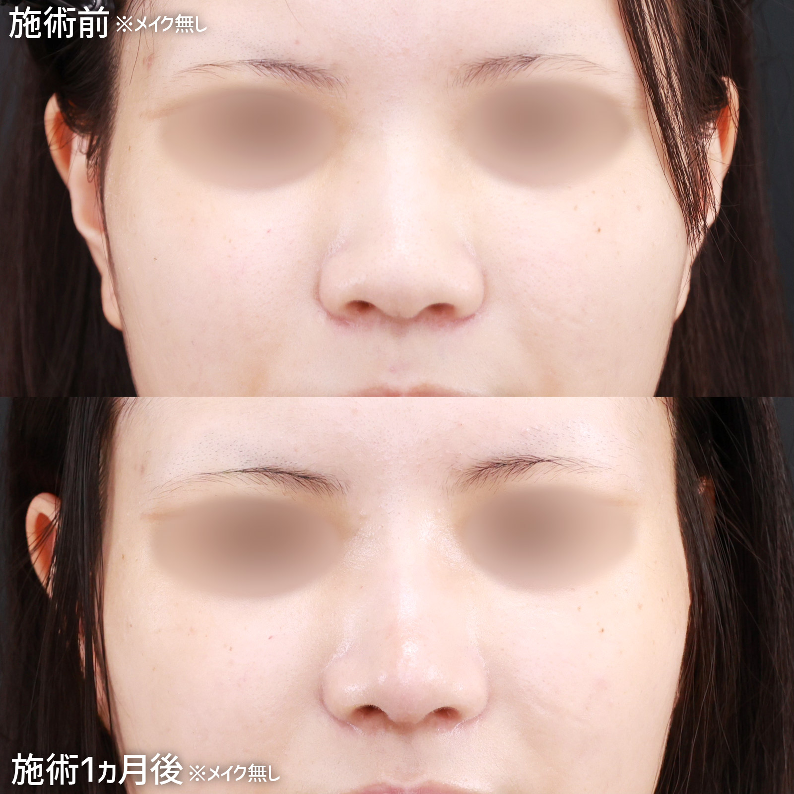 鼻尖形成・鼻尖縮小/鼻先軟骨移植/隆鼻術（プロテーゼ・自家組織）の症例写真 施術前後 