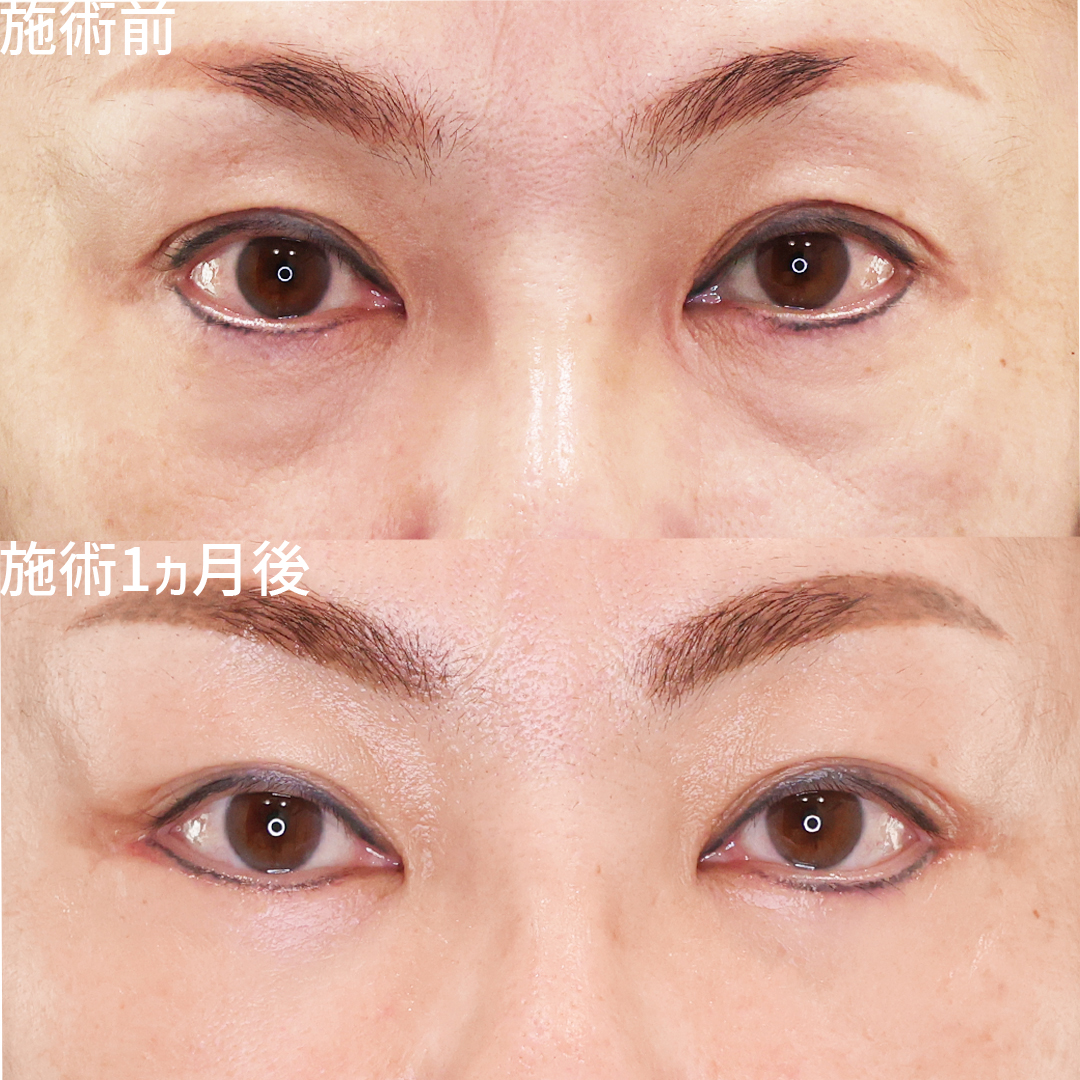 下眼瞼切開術(クマ・たるみとり)の症例写真 施術前後