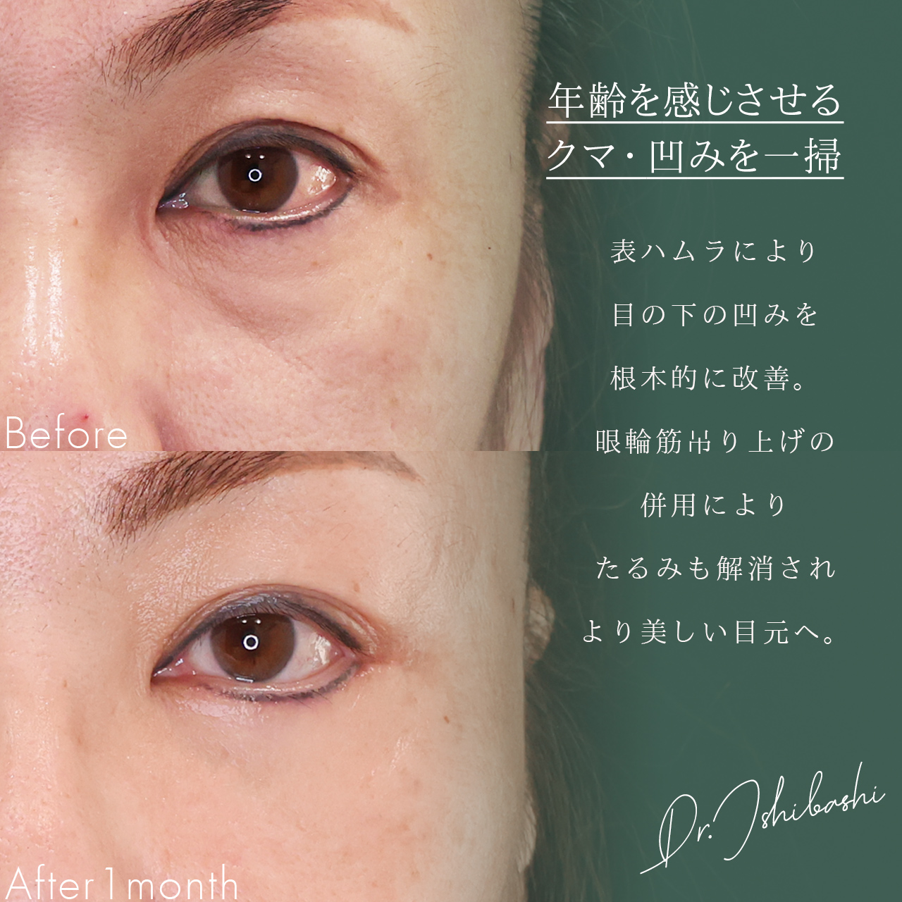 下眼瞼切開術(クマ・たるみとり)の症例写真 施術前後