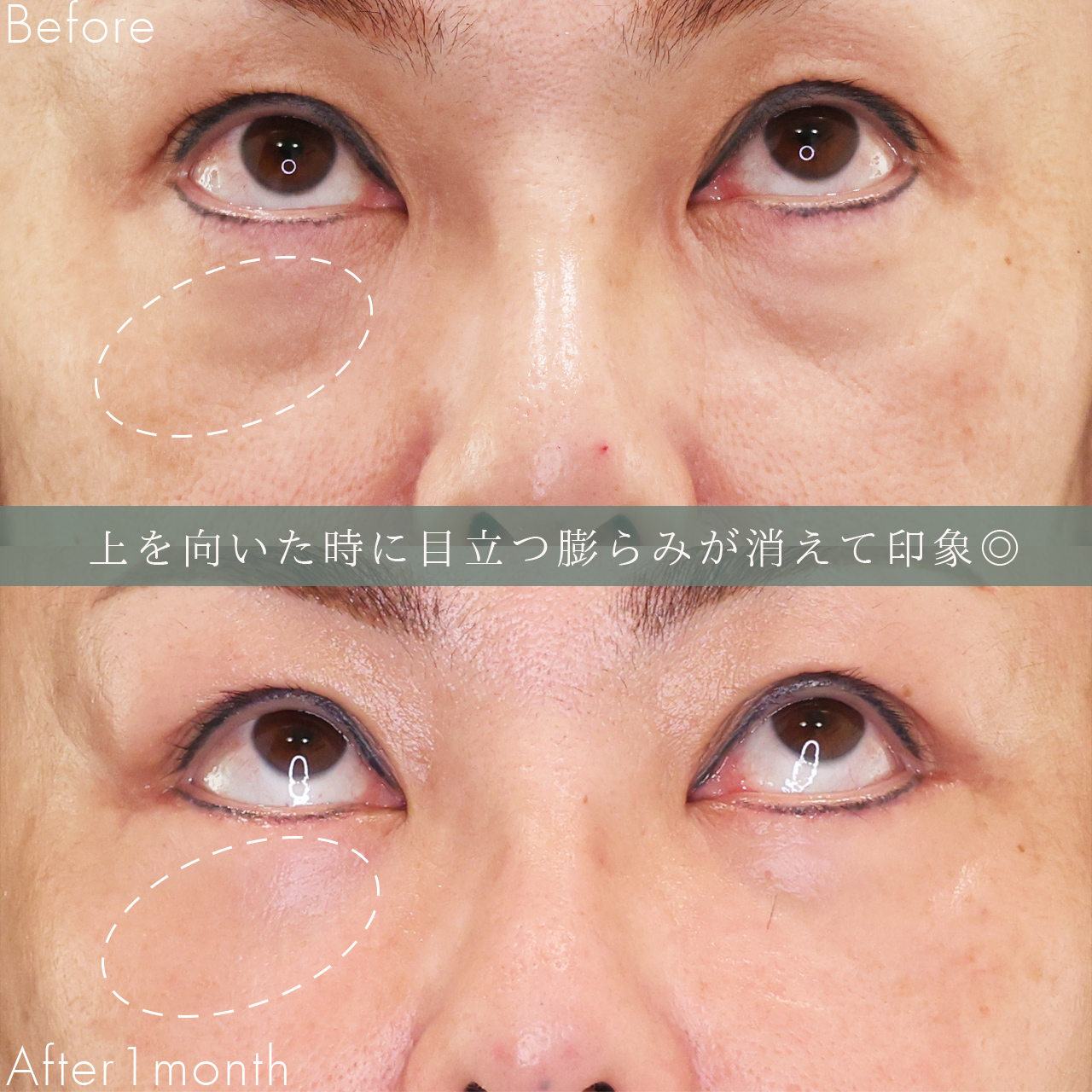 下眼瞼切開術(クマ・たるみとり)の症例写真 施術前後