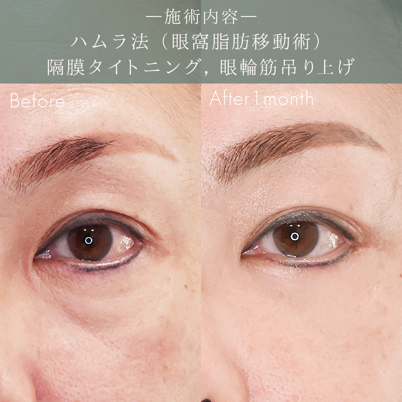 下眼瞼切開術(クマ・たるみとり)の症例写真 施術前後