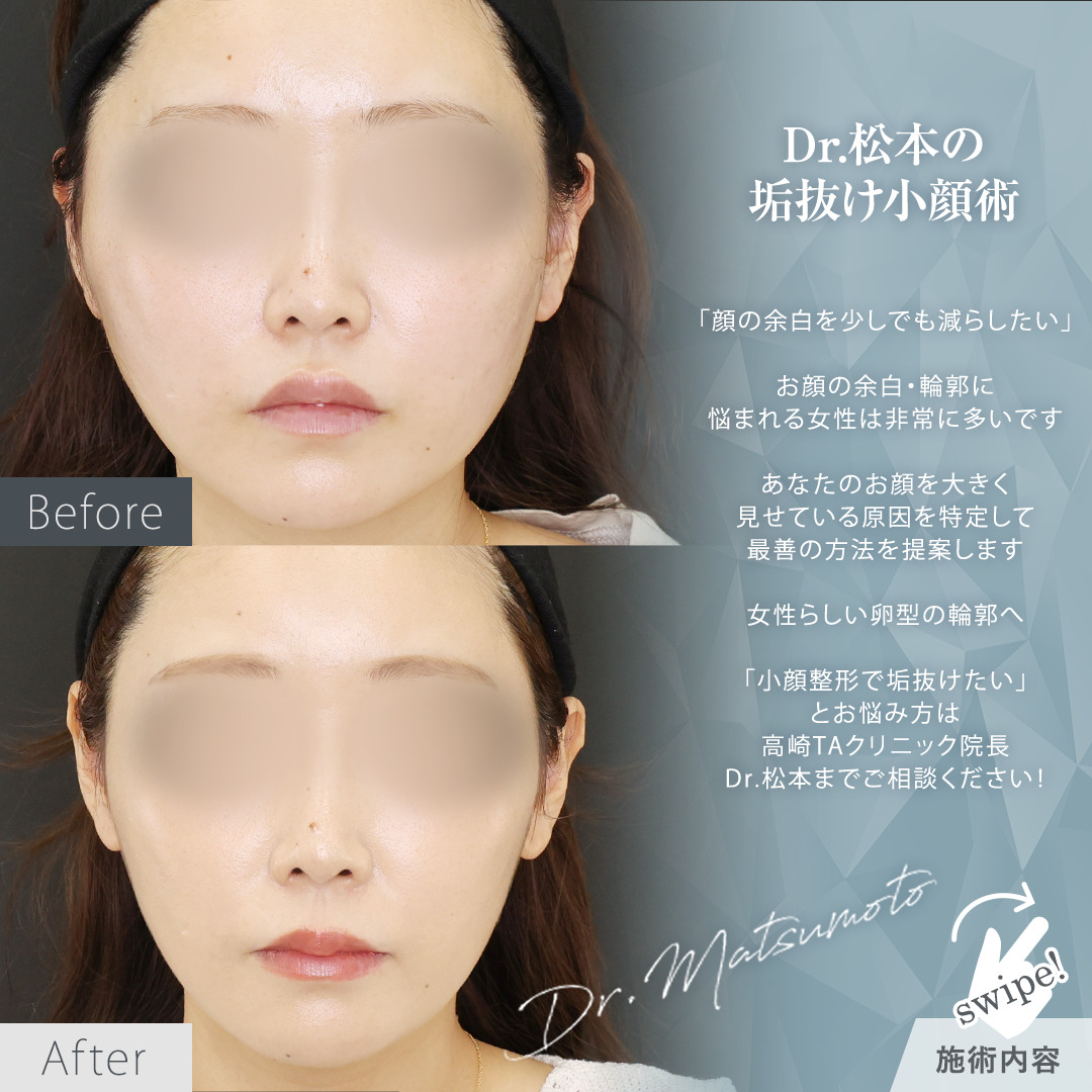 TAC式 ツヤ肌コラーゲンリフト®/エラボトックス注射の症例写真 施術前後 