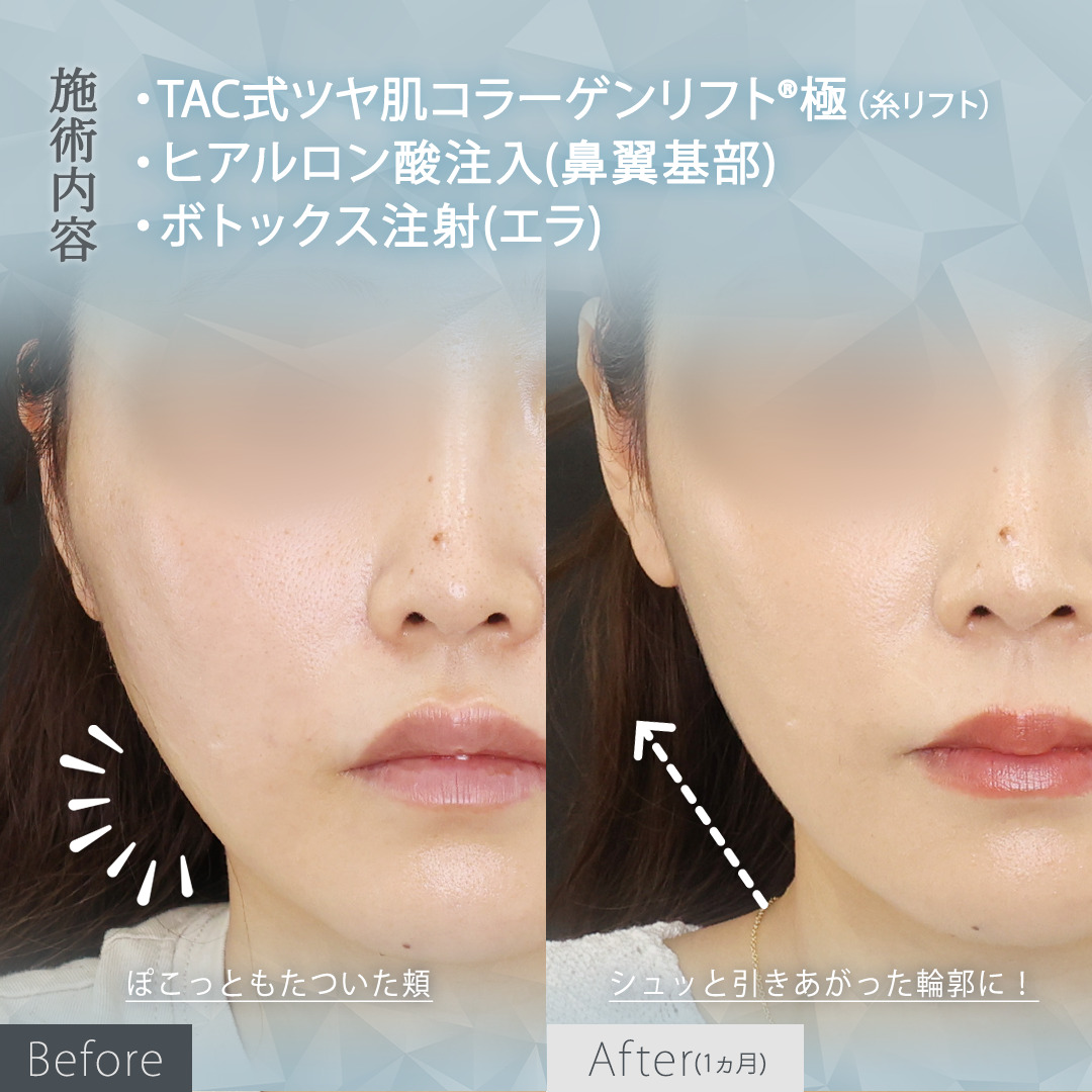 TAC式 ツヤ肌コラーゲンリフト®/エラボトックス注射の症例写真 施術前後 