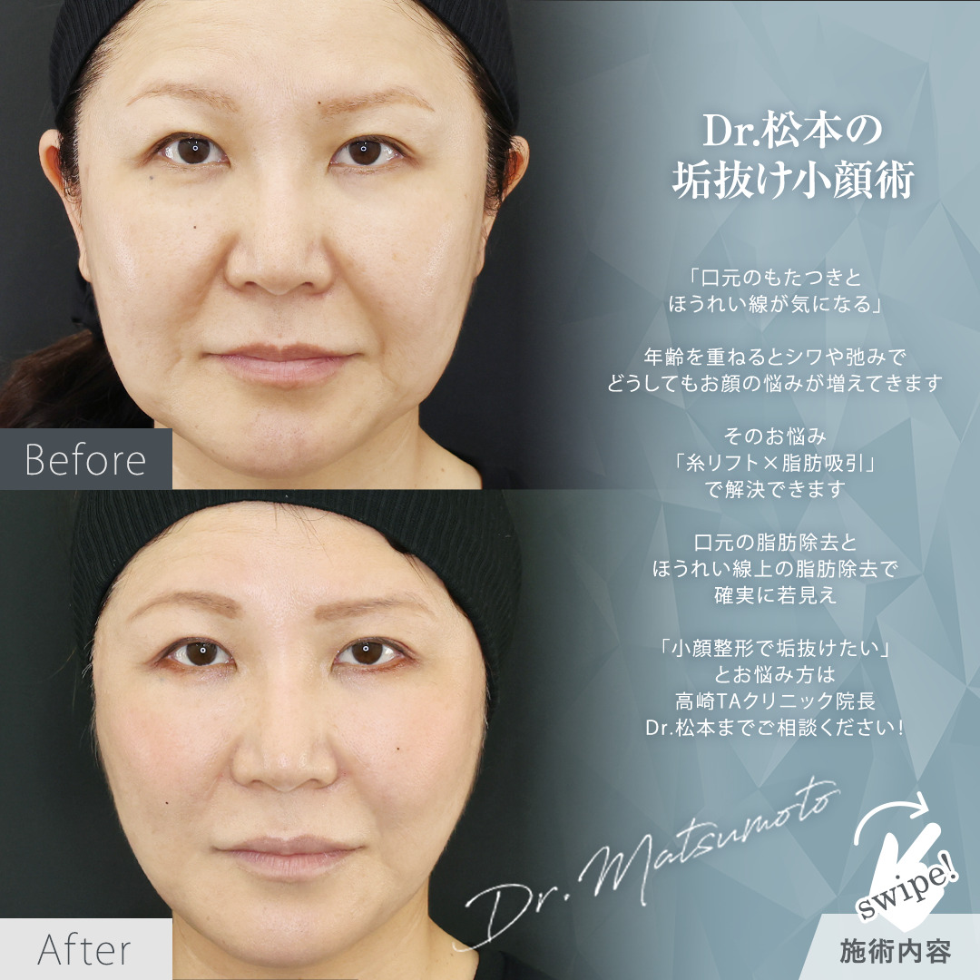 TAC式 ツヤ肌コラーゲンリフト®/ナゾラビアルファット除去/ジョールファット除去の症例写真 施術前後 