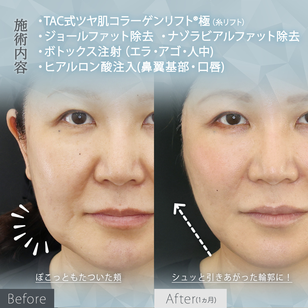 TAC式 ツヤ肌コラーゲンリフト®/ナゾラビアルファット除去/ジョールファット除去の症例写真 施術前後 