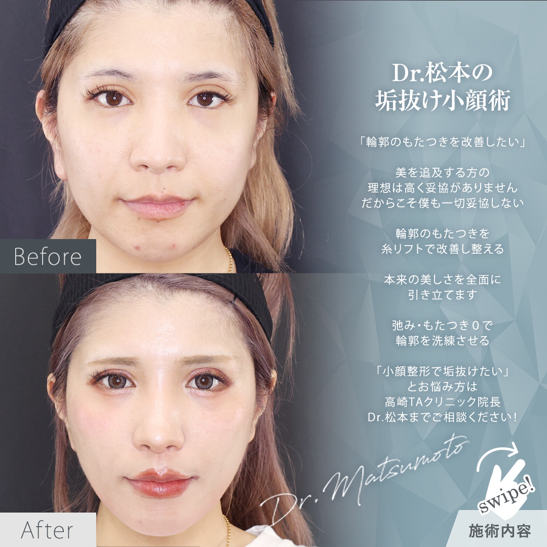 TAC式 ツヤ肌コラーゲンリフト®の症例写真 施術前後 