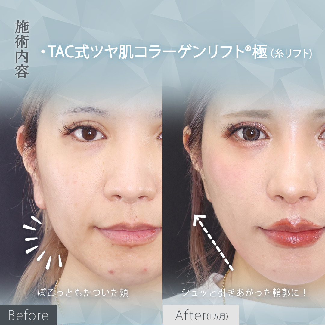 TAC式 ツヤ肌コラーゲンリフト®の症例写真 施術前後 