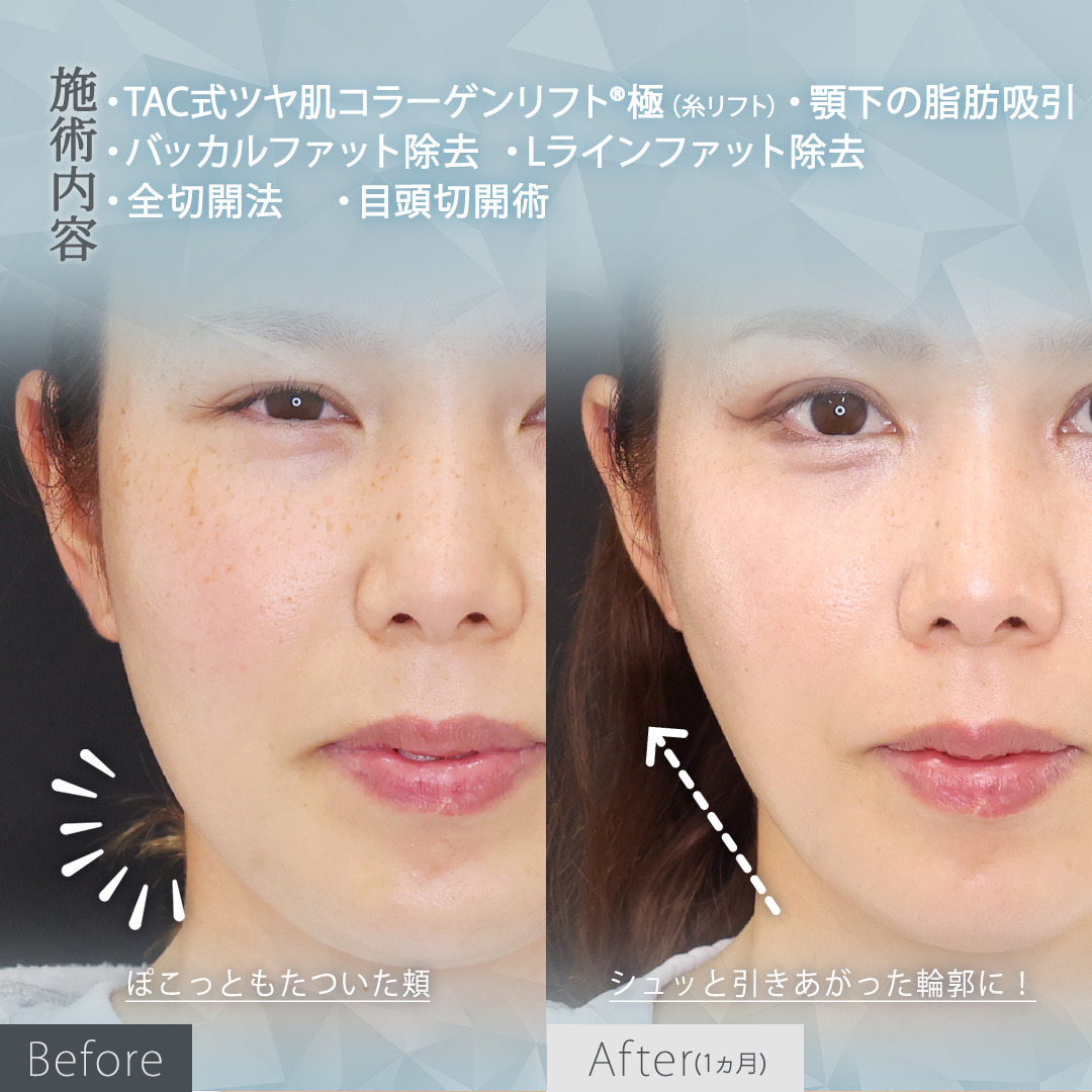 TAC式 ツヤ肌コラーゲンリフト®/バッカルファット除去/Lラインファット除去（エラ下脂肪除去）の症例写真 施術前後 