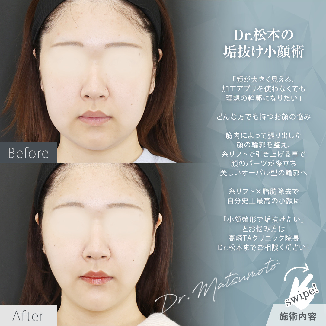 TAC式 ツヤ肌コラーゲンリフト®/バッカルファット除去/Lラインファット除去（エラ下脂肪除去）の症例写真 施術前後 