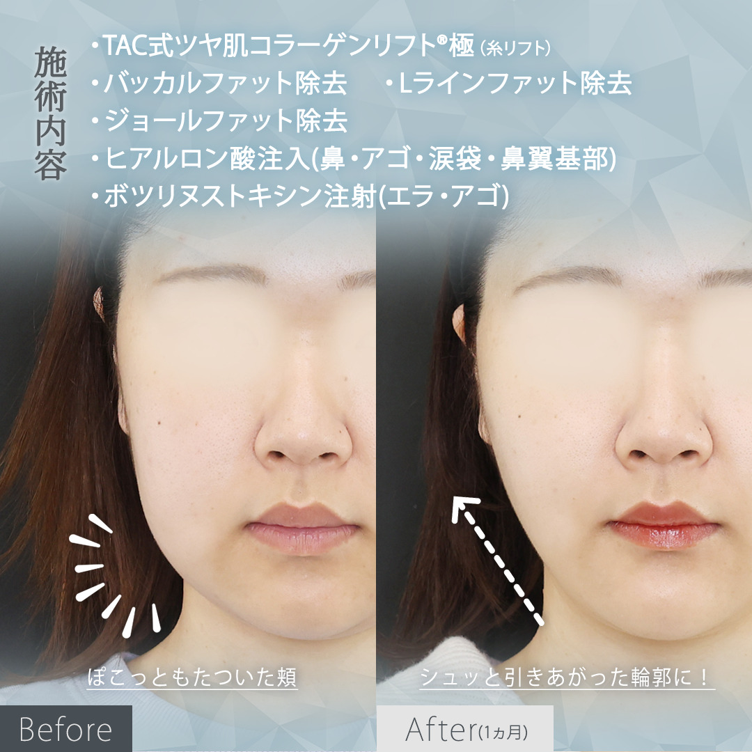 TAC式 ツヤ肌コラーゲンリフト®/バッカルファット除去/Lラインファット除去（エラ下脂肪除去）の症例写真 施術前後 