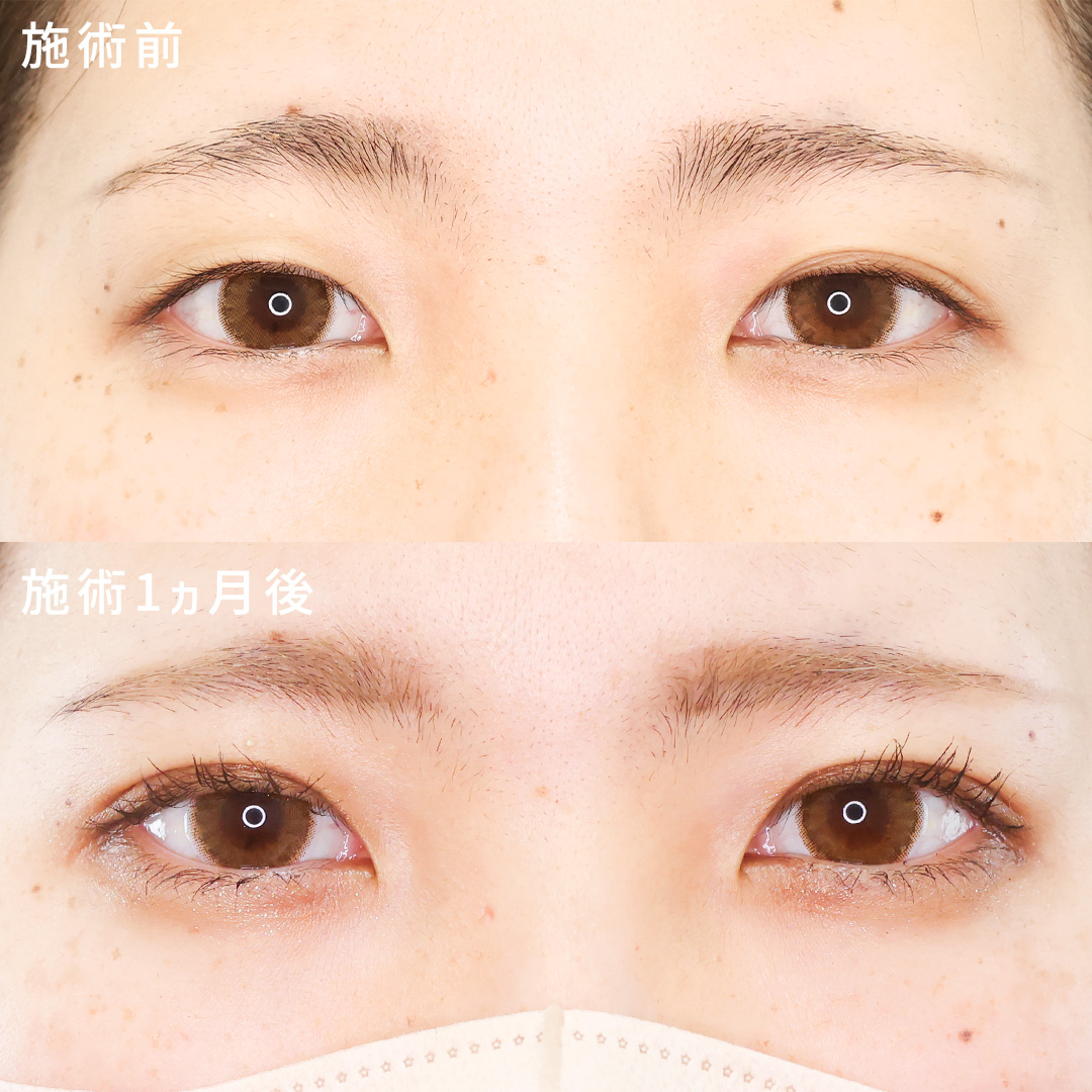 幅をそろえナチュラルな末広二重に