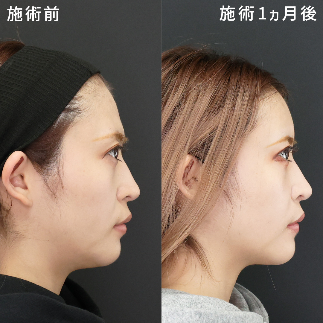 おでこの脂肪注入でバブみ感UP