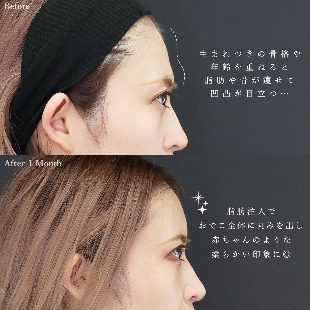 顔の脂肪注入(コンデンスリッチフェイス)の症例写真 施術前後