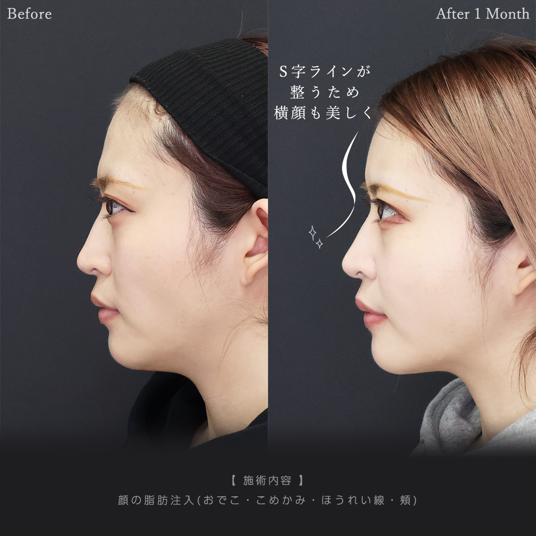 顔の脂肪注入(コンデンスリッチフェイス)の症例写真 施術前後