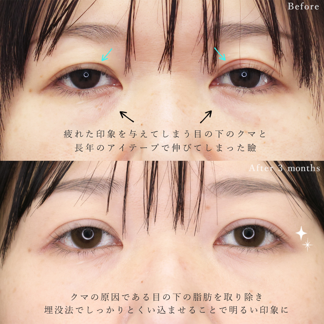 二重埋没法/下眼瞼脱脂術（目の下のたるみ取り・目の下の脂肪ふくらみ取り）/TAC式 ツヤ肌コラーゲンリフト®の症例写真 施術前後 