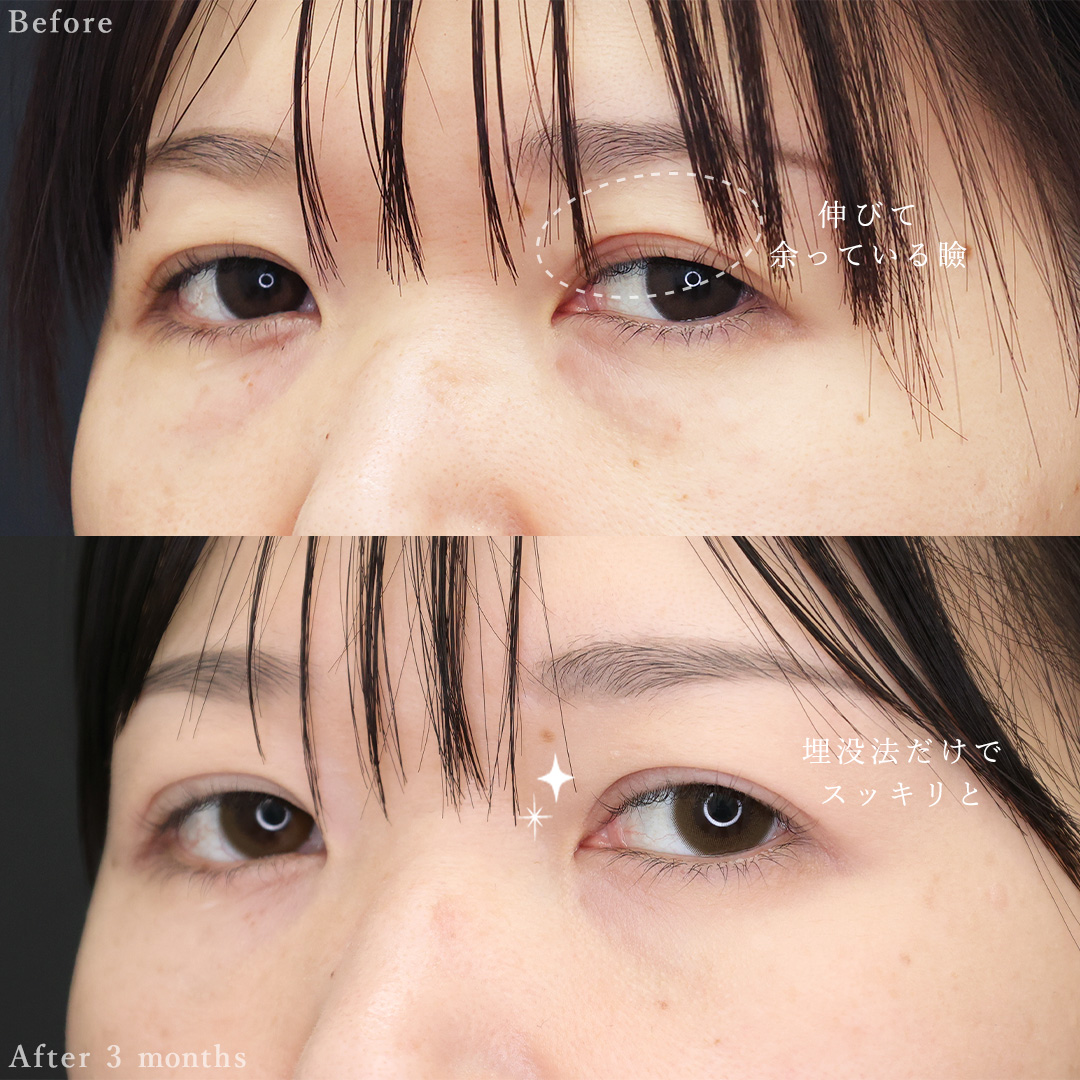 二重埋没法/下眼瞼脱脂術（目の下のたるみ取り・目の下の脂肪ふくらみ取り）/TAC式 ツヤ肌コラーゲンリフト®の症例写真 施術前後 