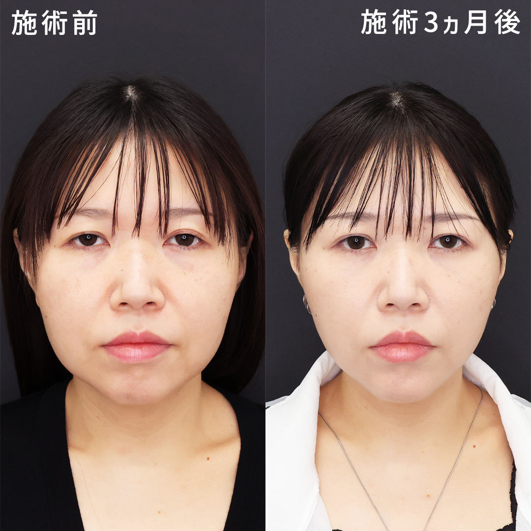 形成外科専門医の【クマ取り×埋没×小顔整形】オーダーメイド小顔術