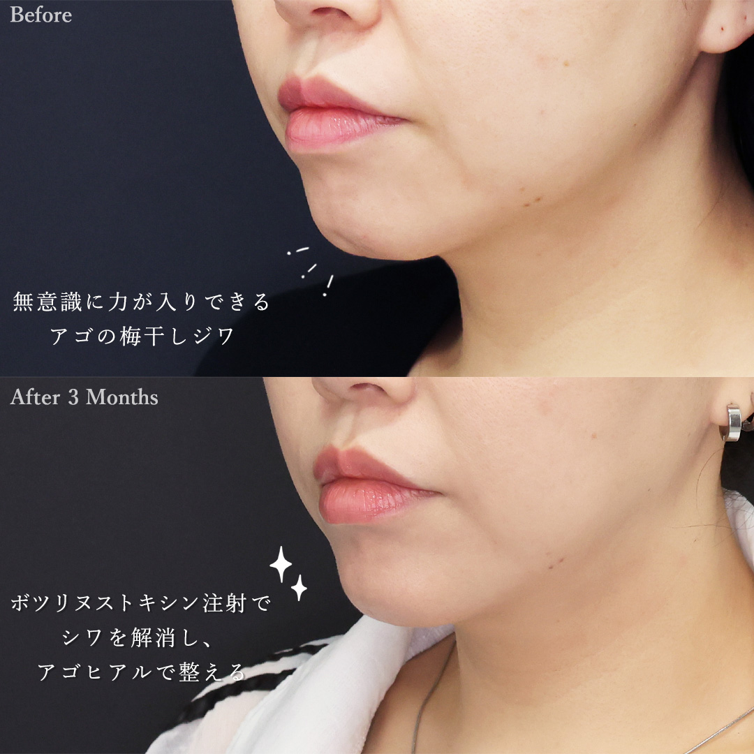 二重埋没法/下眼瞼脱脂術（目の下のたるみ取り・目の下の脂肪ふくらみ取り）/TAC式 ツヤ肌コラーゲンリフト®の症例写真 施術前後 