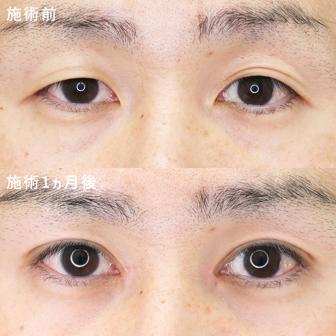 【メンズ30代】二重埋没法＋目頭切開術で印象的なお目元に