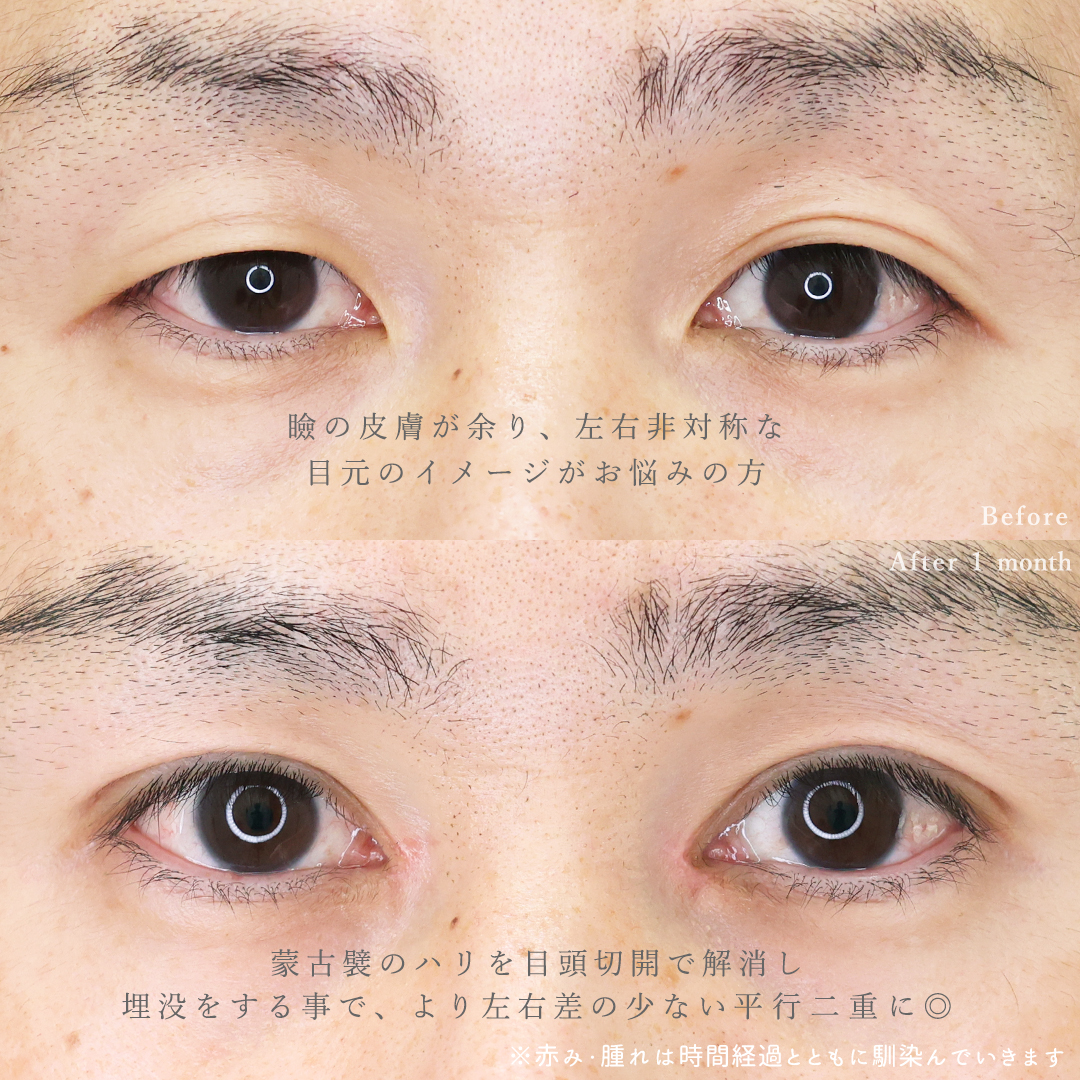 二重埋没法/目頭切開術の症例写真 施術前後 