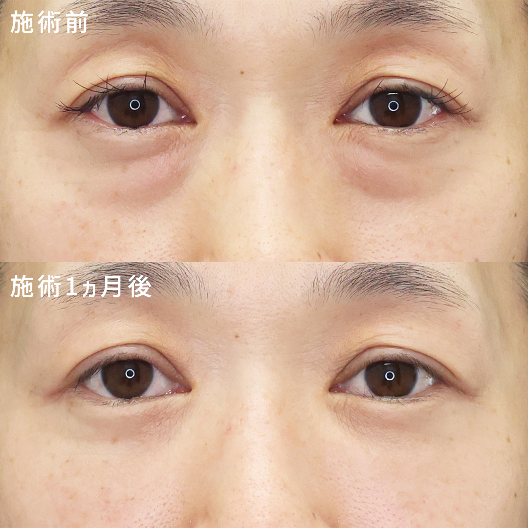 【疲れ顔解消】40代女性の目の下のクマ取り