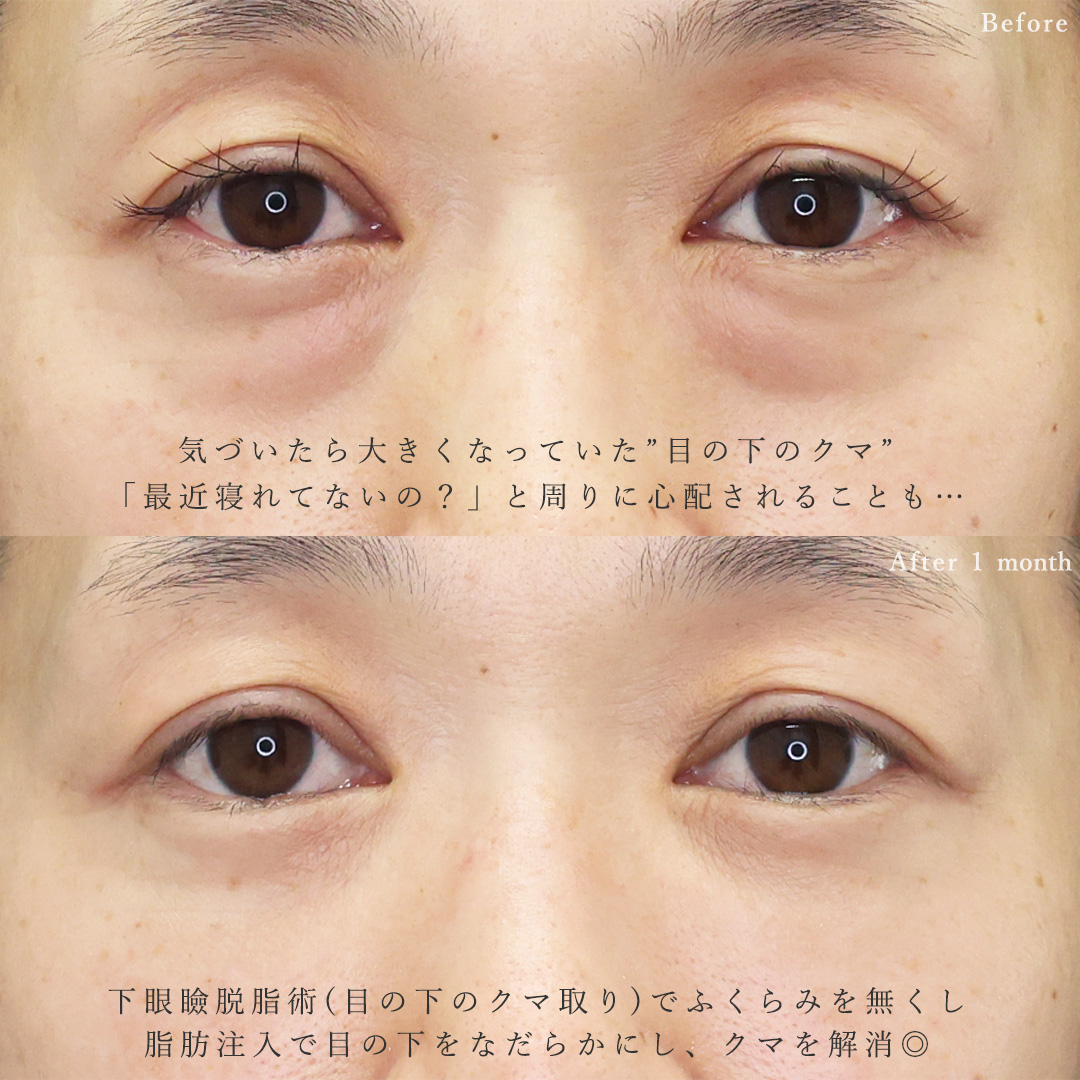 下眼瞼脱脂術(目の下のたるみ取り・目の下の脂肪ふくらみ取り)/顔の脂肪注入(コンデンスリッチフェイス)の症例写真 施術前後