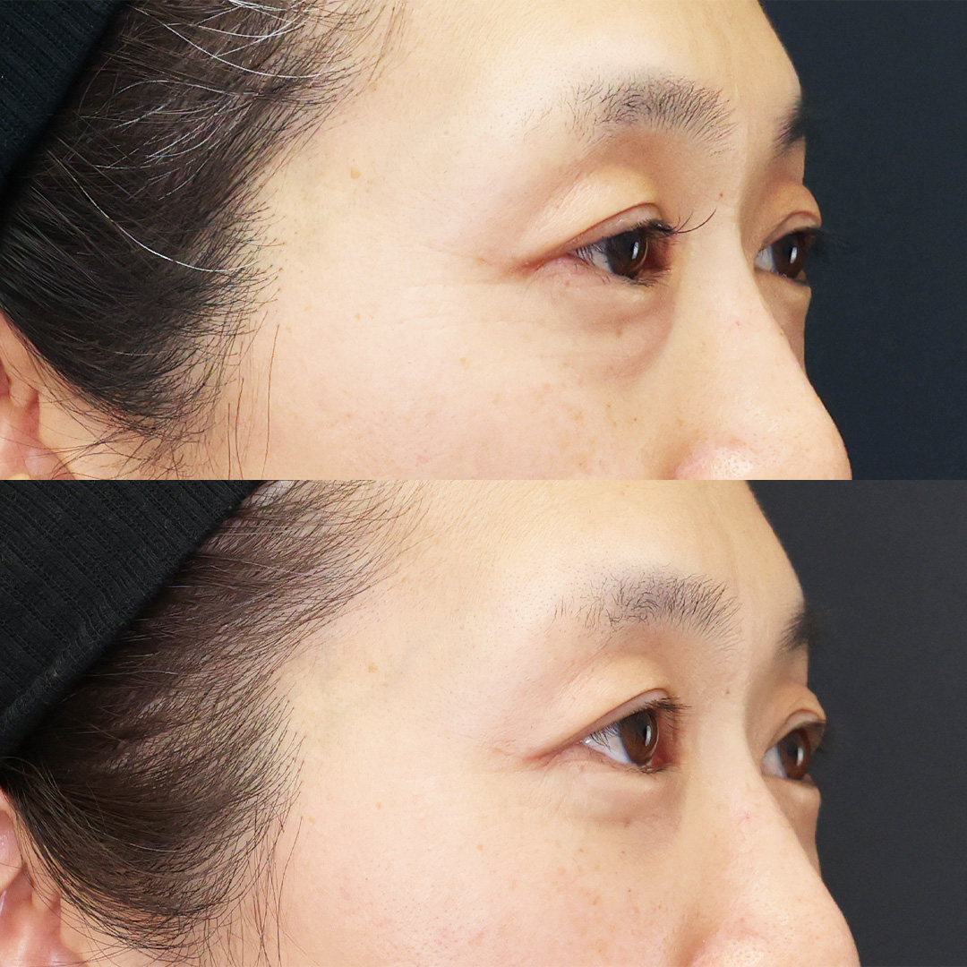 下眼瞼脱脂術(目の下のたるみ取り・目の下の脂肪ふくらみ取り)/顔の脂肪注入(コンデンスリッチフェイス)の症例写真 施術前後