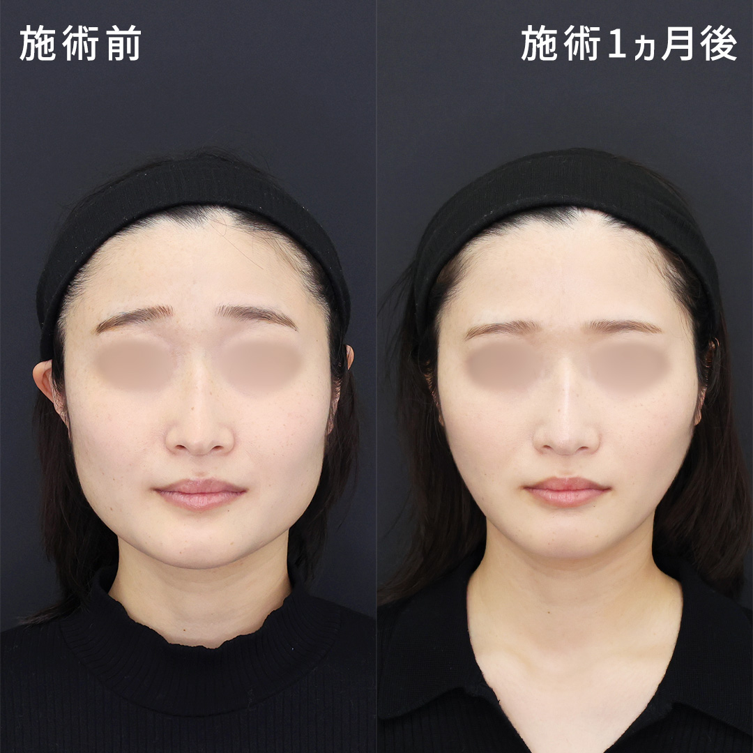 【小顔整形】ホームベース型の輪郭を卵型に