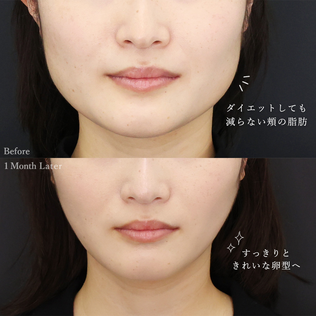 TAC式 ツヤ肌コラーゲンリフト®/顔の脂肪吸引の症例写真 施術前後 