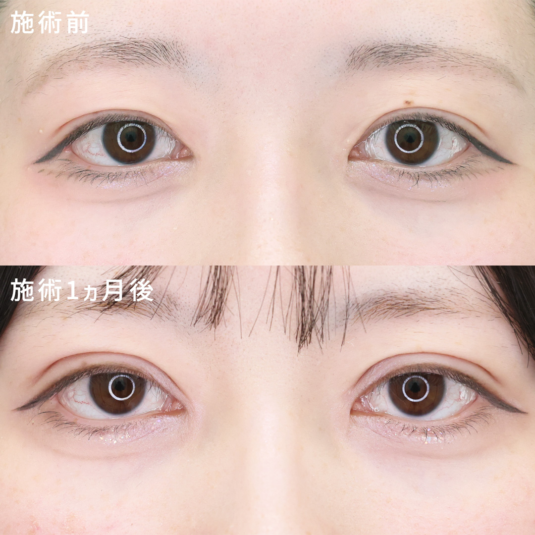 《埋没法で叶える》印象的な平行二重