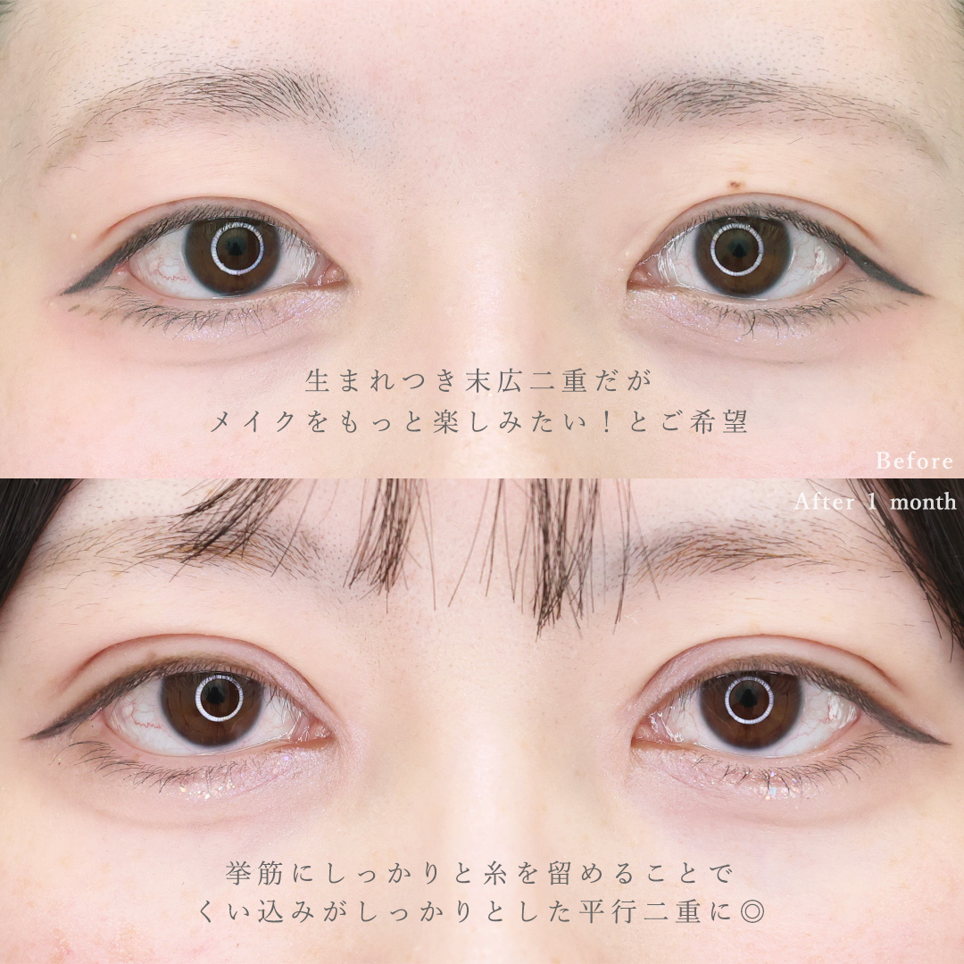 二重埋没法の症例写真 施術前後 